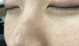 挤黑头引起了色素沉着怎么去除 我们可以从饮食入手